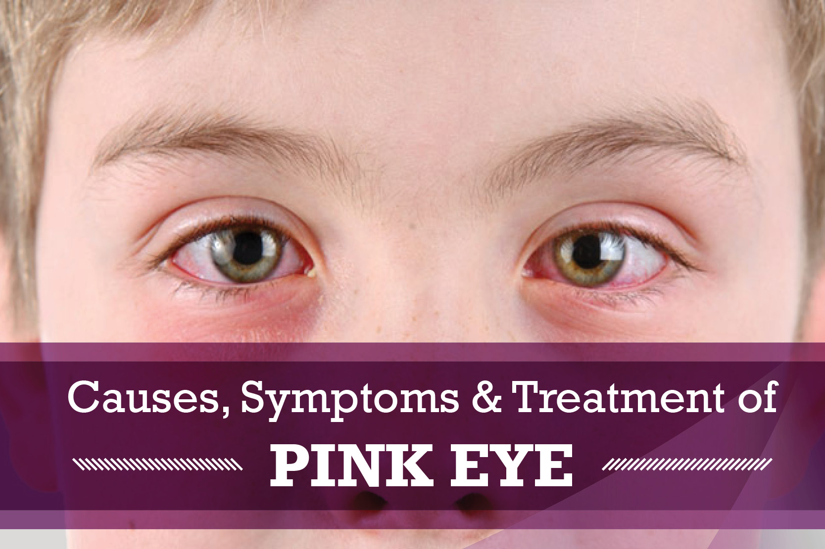 common-eye-infections-diagnosing-and-treating-pink-eye